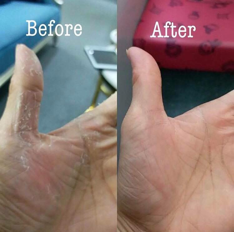 Eczema Treatment Cream - Adult Formula (also suitable for Contact Dermatitis) 45ml